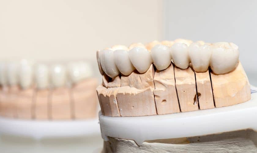 Dental Bridge