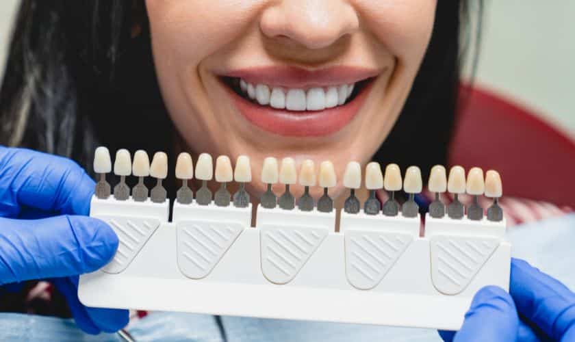 Dental professional holding tooth shade guide showing various porcelain veneer color options for cosmetic dentistry.