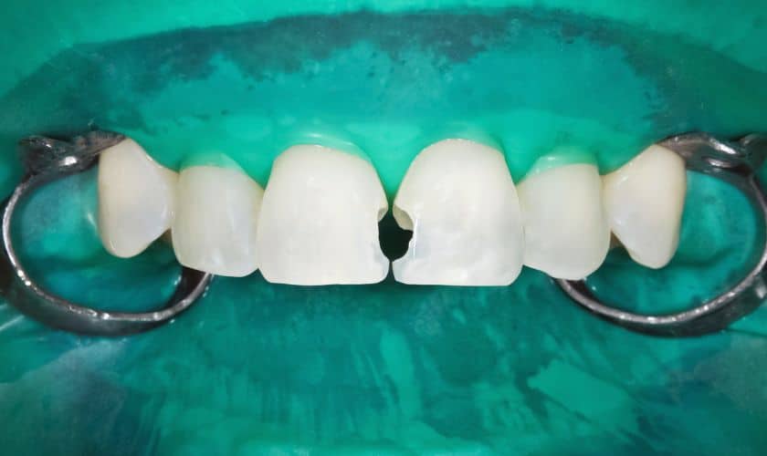 Cracked Teeth