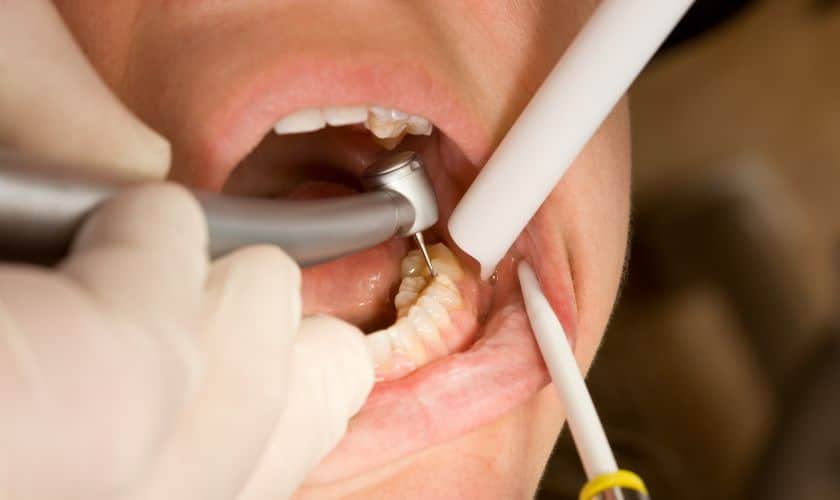Fill A Cavity