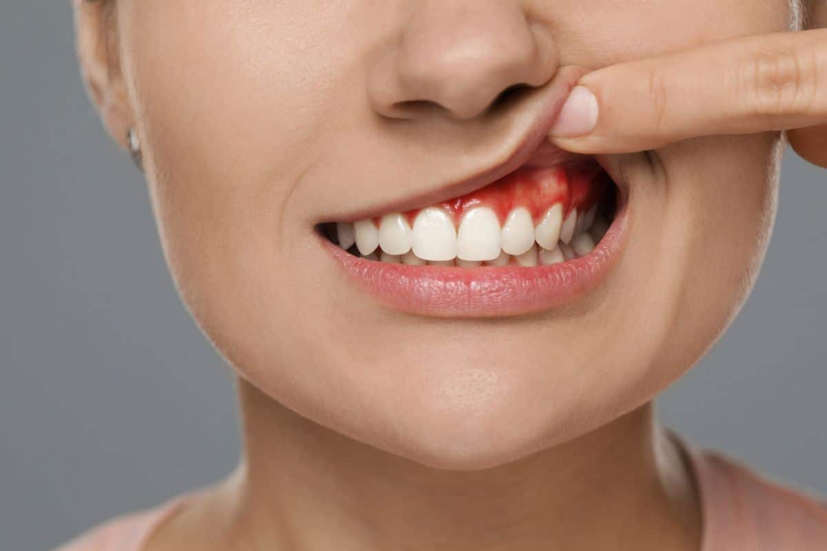 Treat Gingivitis