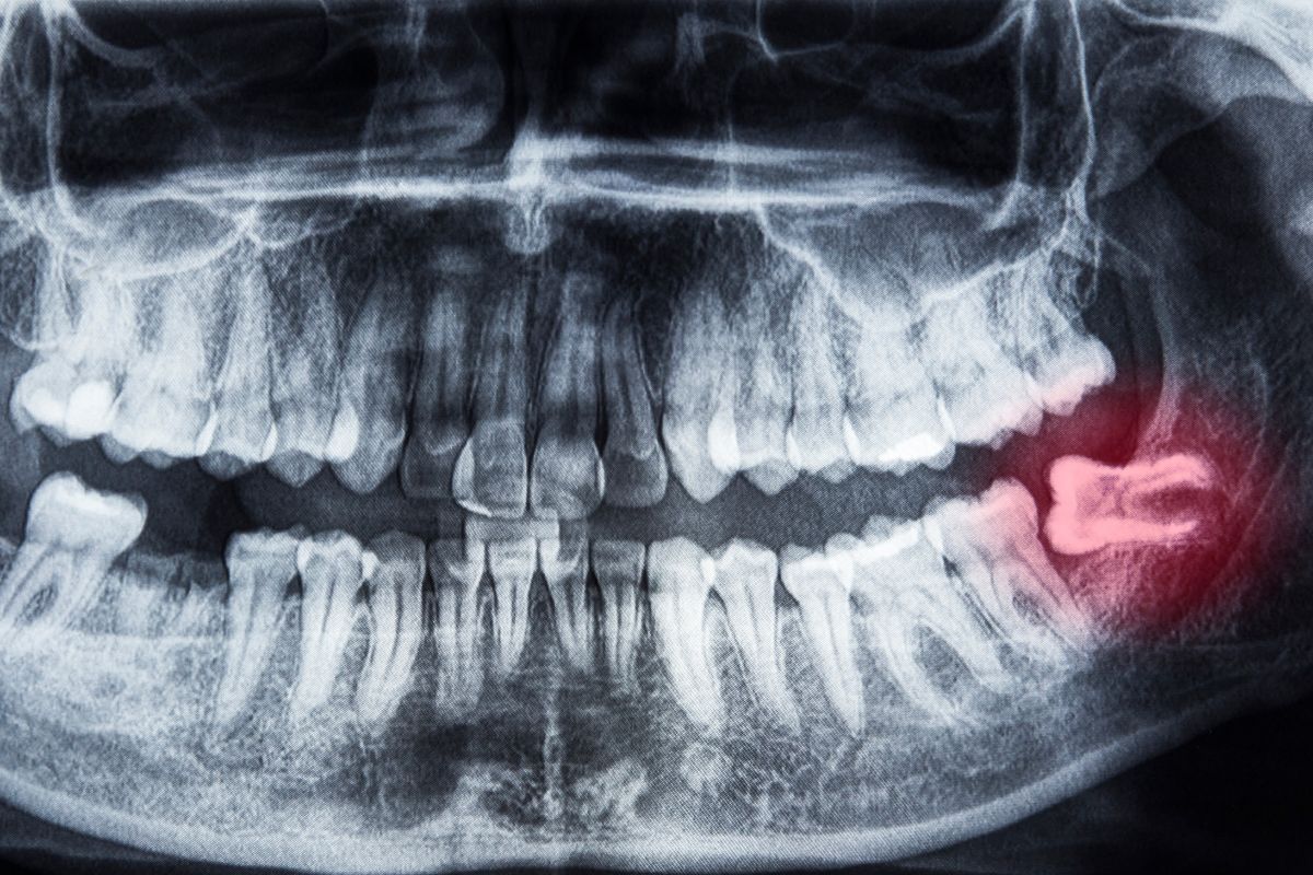 wisdom tooth