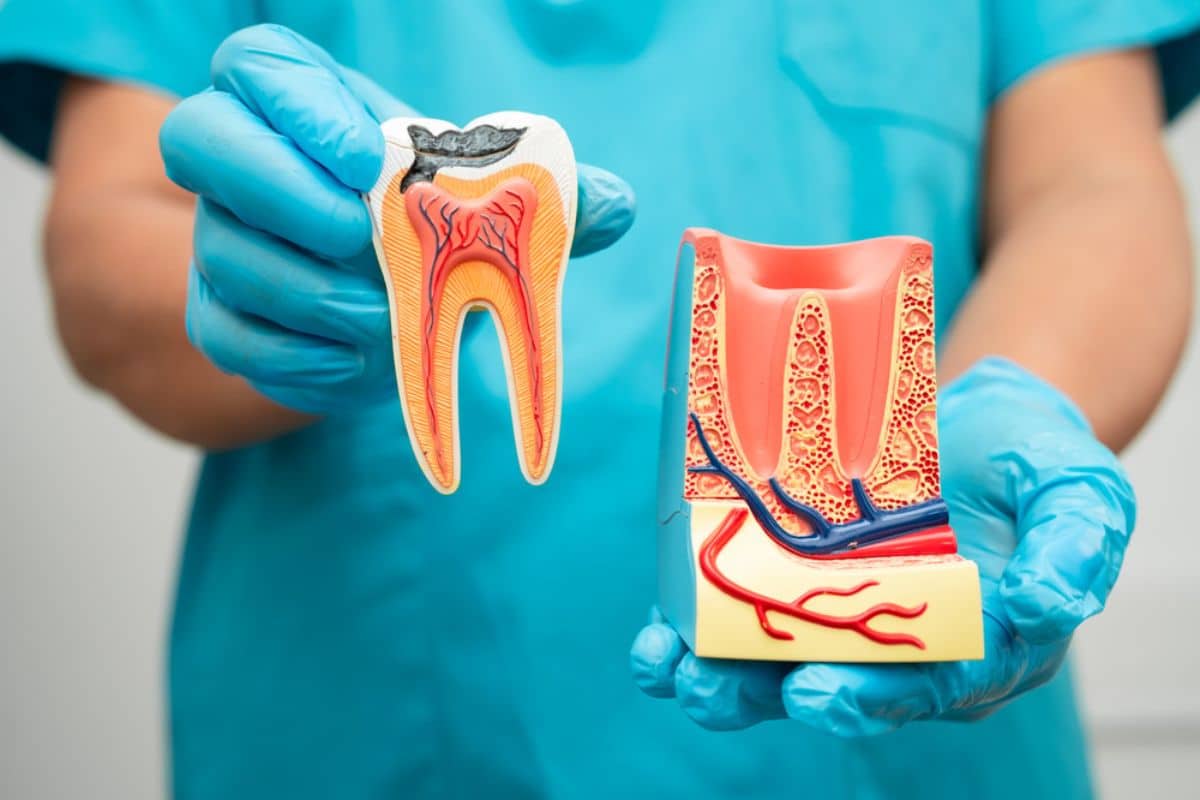 Top Causes of Tooth Infections Requiring Root Canals