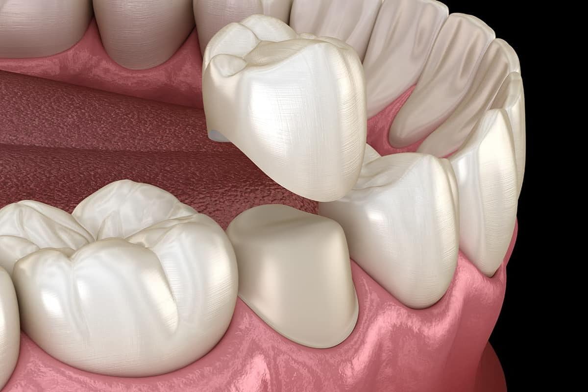 The Role of Dental Crowns
