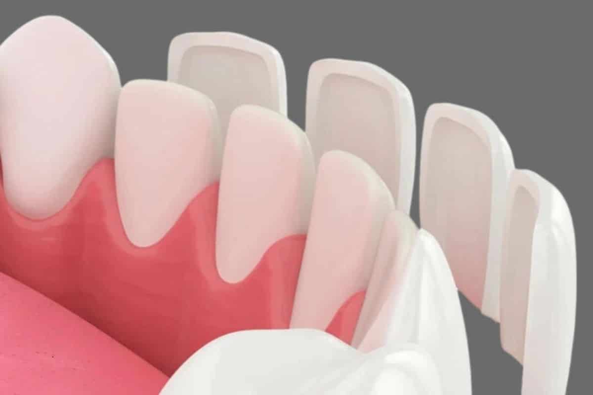 How Long Do Dental Veneers Last