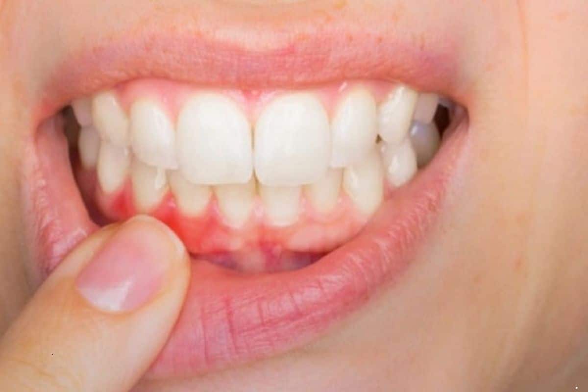Say Goodbye to Gum Line Cavities