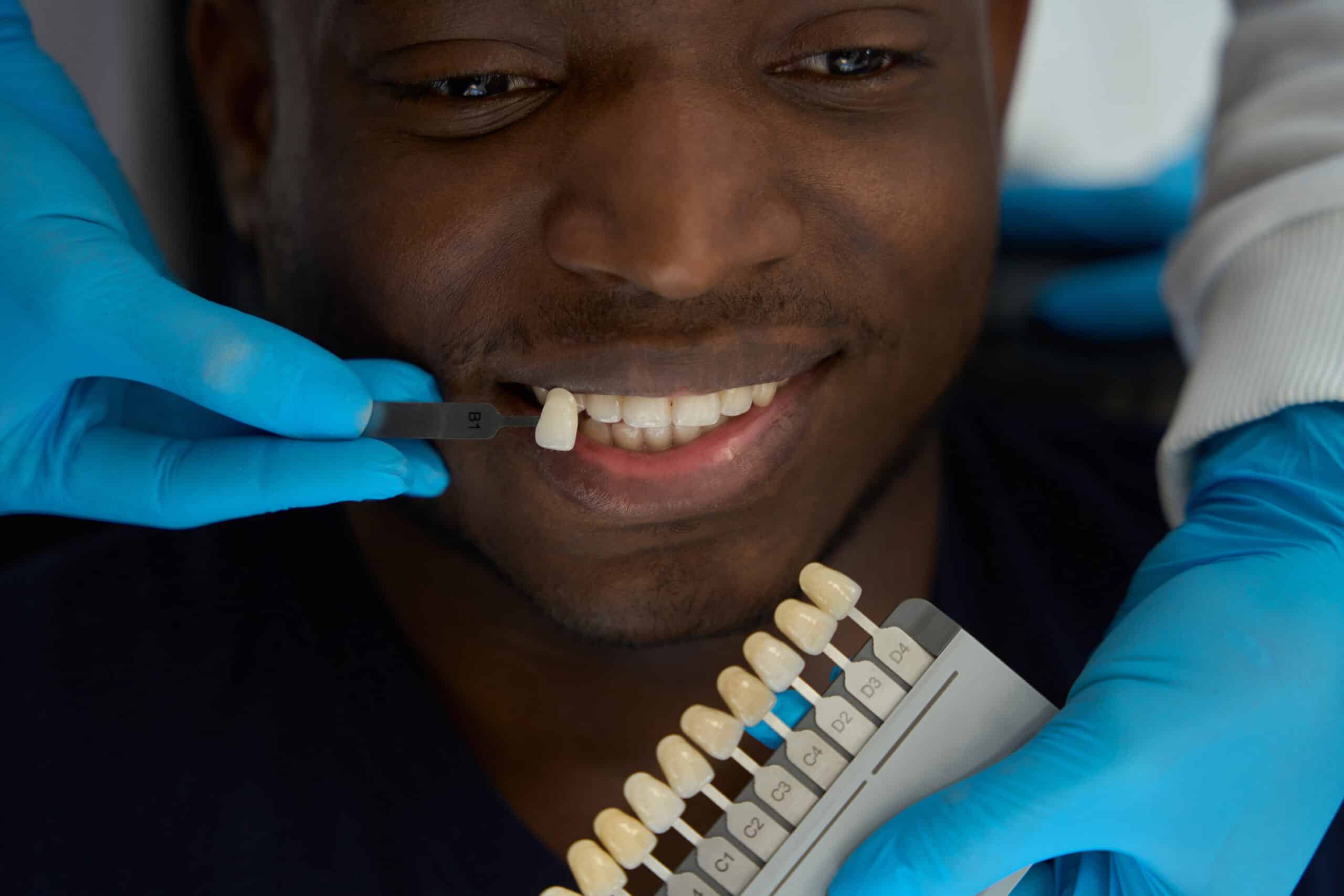 Porcelain vs. Composite Veneers: Which Lasts Longer and Costs Less